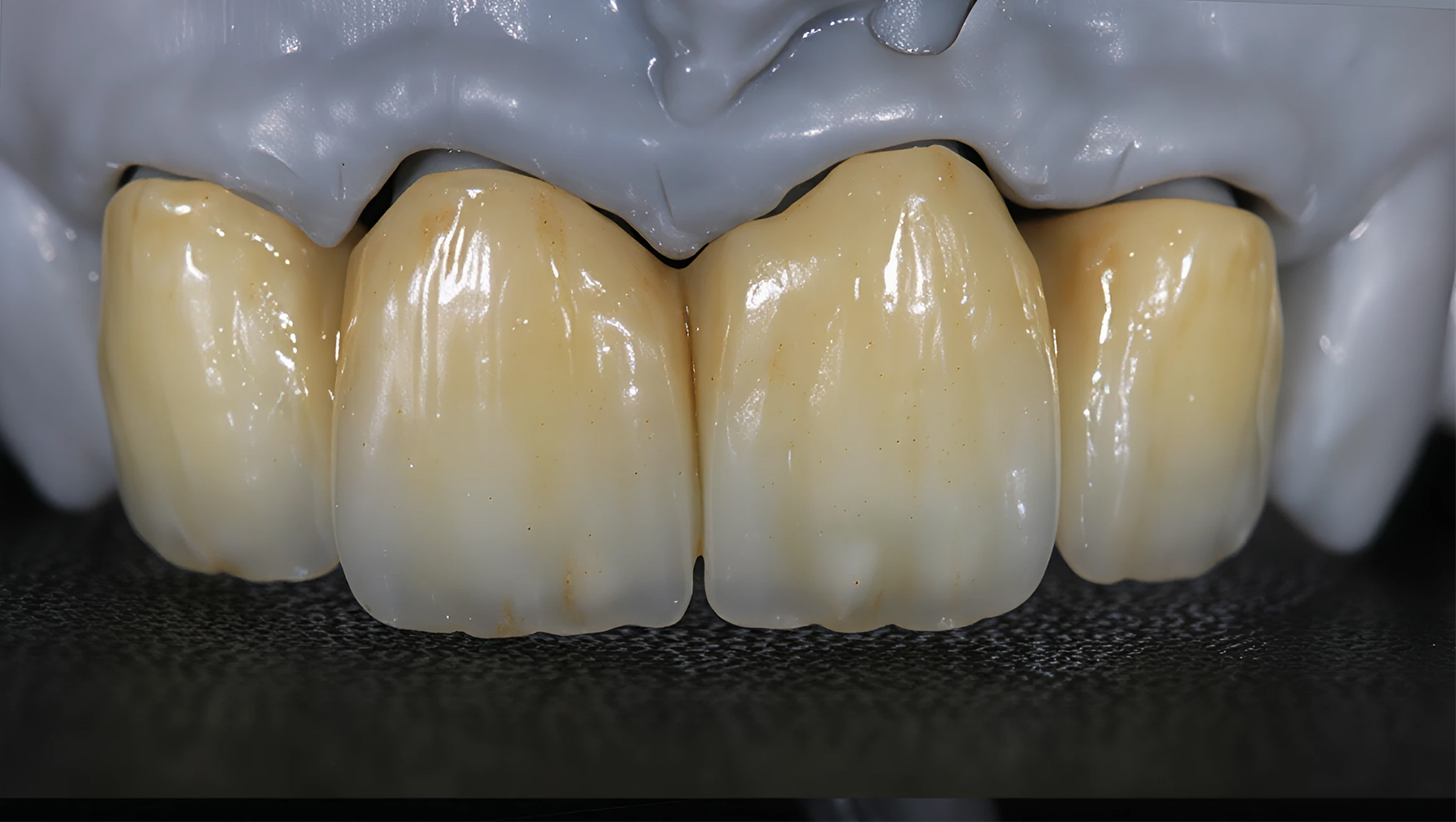 Zirconia Stratificata Digital Dental Hub