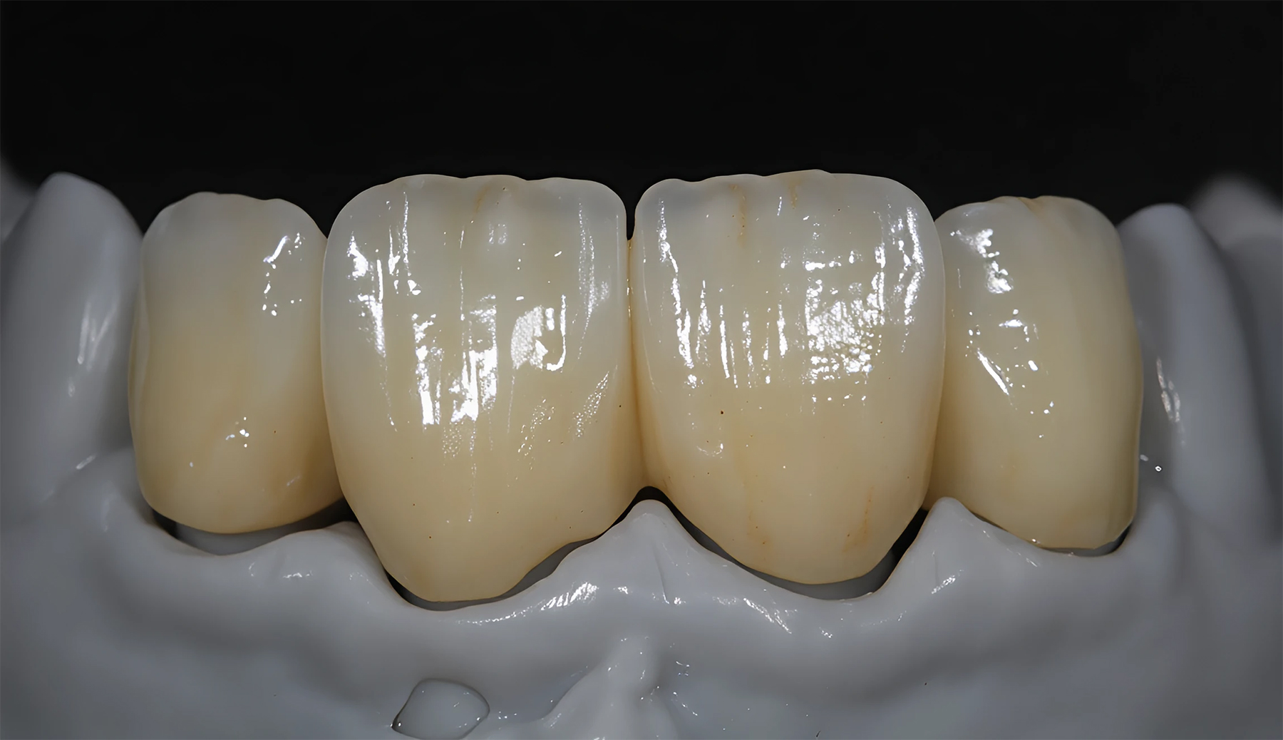 Zirconia Stratificata DDH
